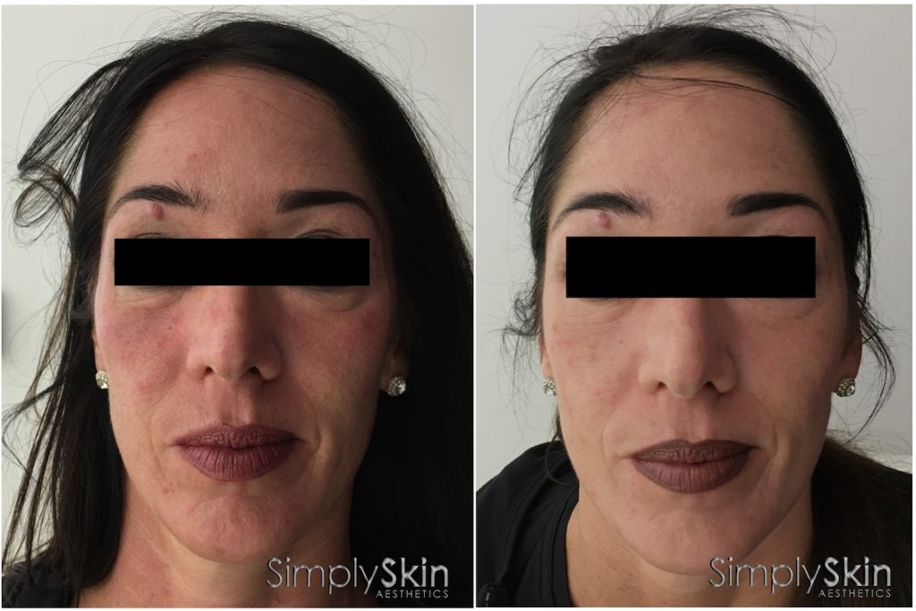 vampire-face-lift-before-after