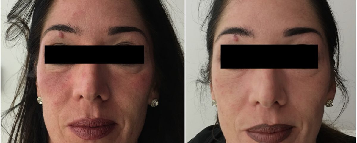 vampire-face-lift-before-after