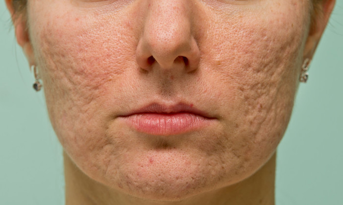 Frontal view of girl's cheeks and chin with acne scars