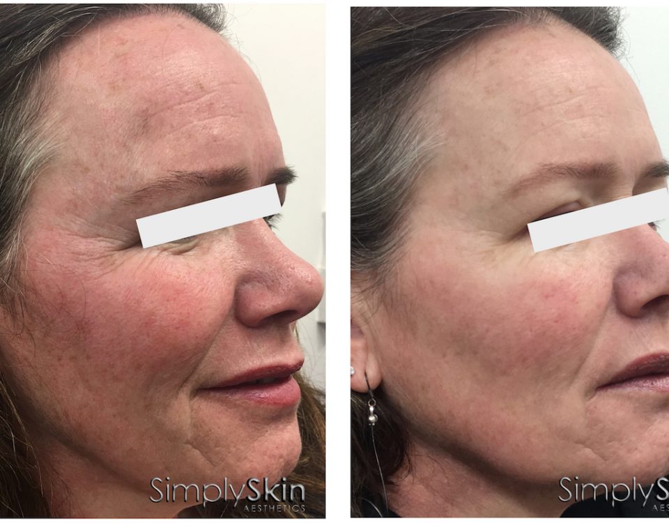Middle aged female before and after PRP for skin