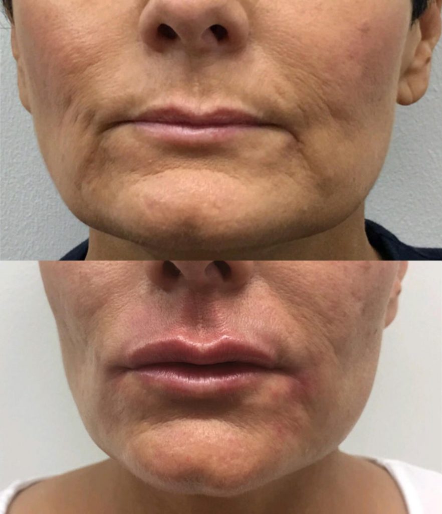 Rejuvenation of the lower face with fillers to reduce marionette lines and enhance maxilla and lip volume