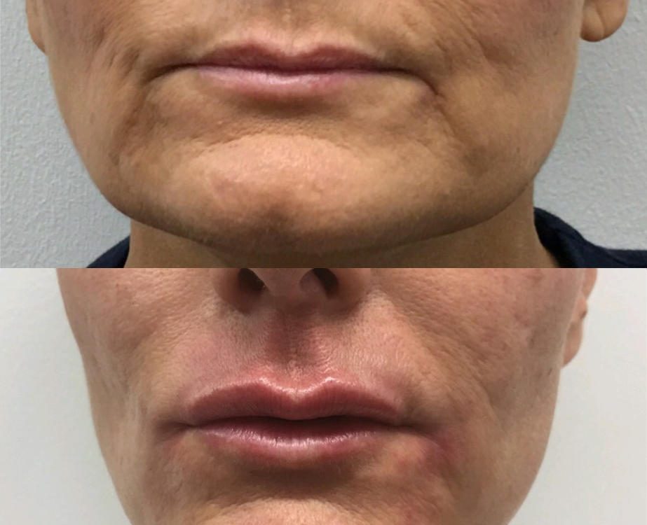 Rejuvenation of the lower face with fillers to reduce marionette lines and enhance maxilla and lip volume
