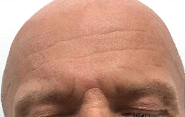 forehead-wrinkles-botox-after