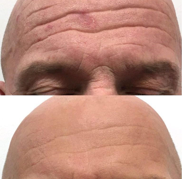 Male with deep forehead lines