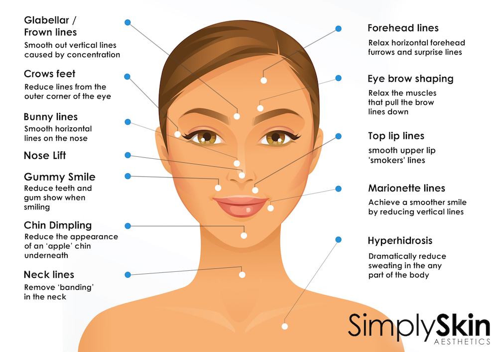 botox injection areas at simplyskin clinic earls court